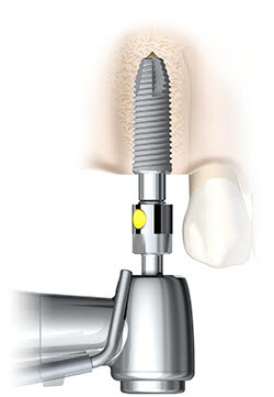 Illustration of medical drill in tooth cavity