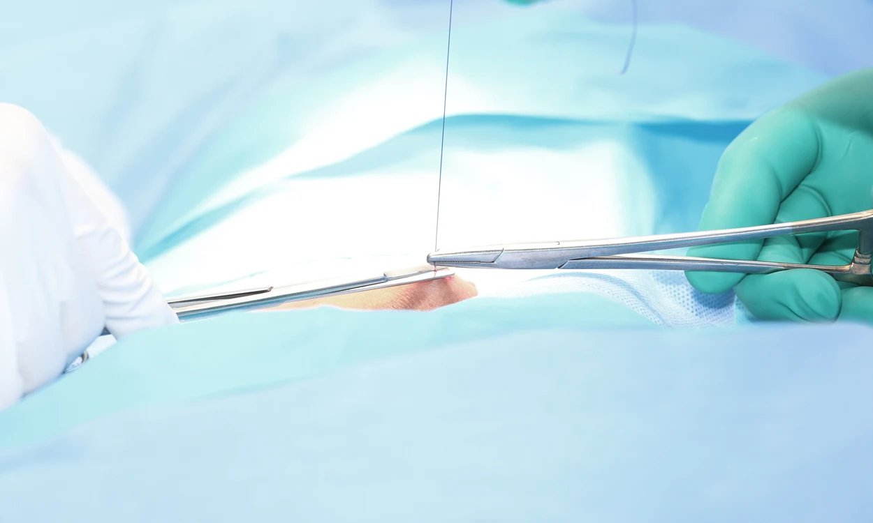 ETO-sterilized surgical sutures